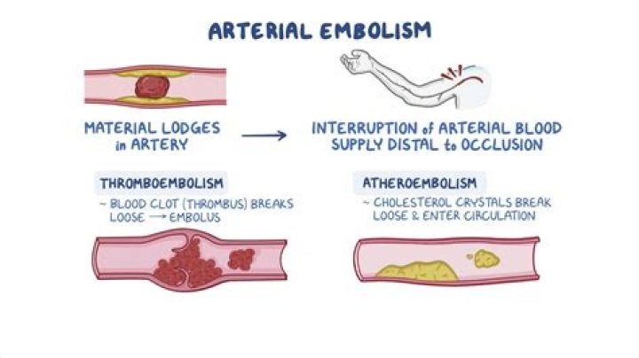 What cardiac condition causes most upper extremity emboli?